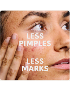 veido serumas nuo spuogų,... 2